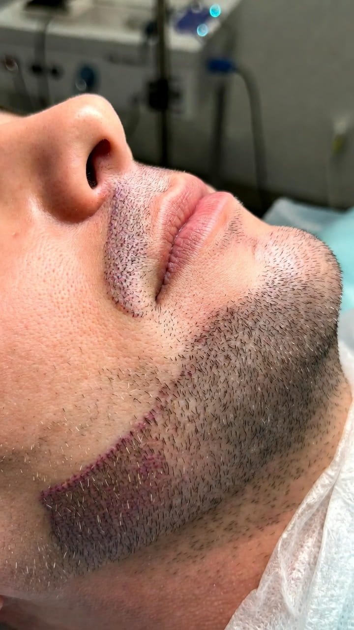 Beard Transplant
