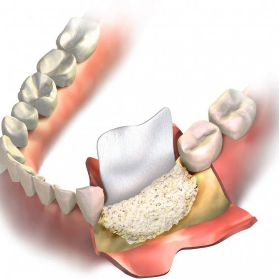 Bone graft