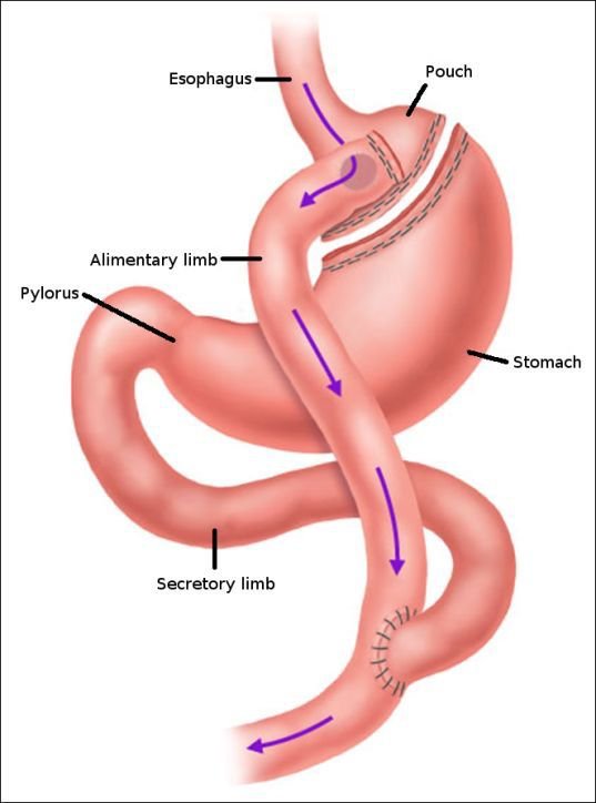 Gastric bypass