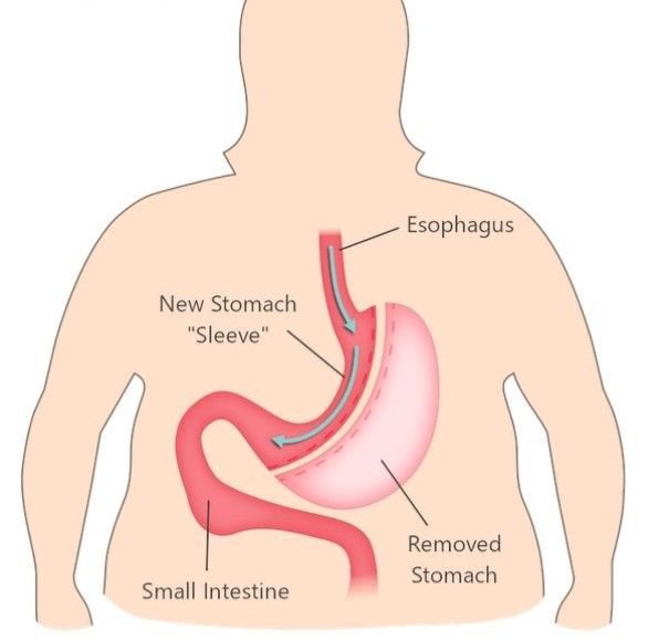 Gastric sleeve