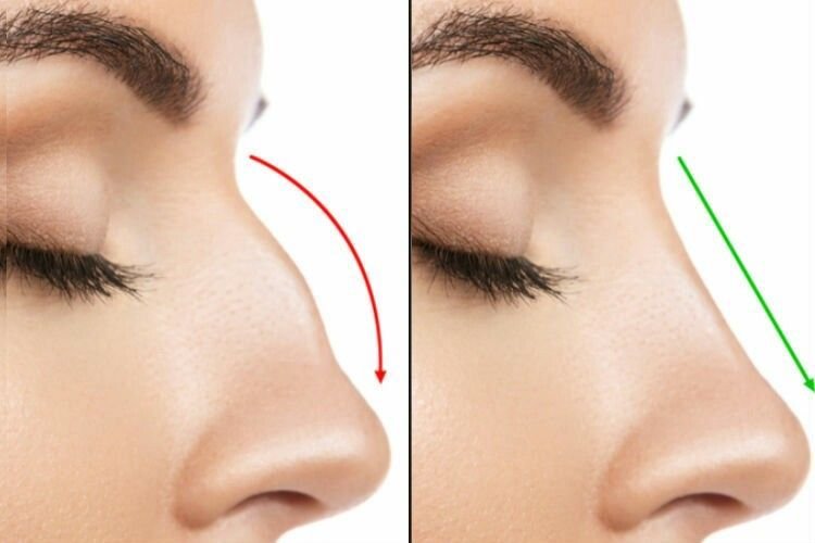 Rhinoplastie